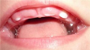 Прорезывание молочных зубов