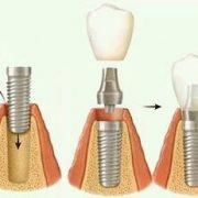 Имплантация в день удаления зуба