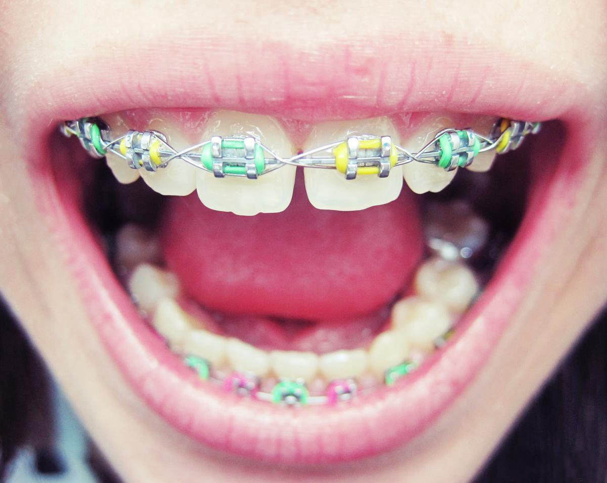 Брекеты на зубы для детей сколько стоят. Брекеты металлические лигатурные (2 челюсти).