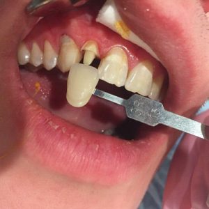 лечение пульпита и восстановление зуба
