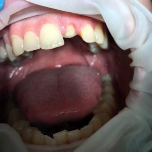 Переломо зуба