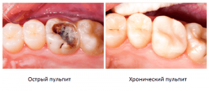 На левом фото снят острый пульпит, на правом – хронический