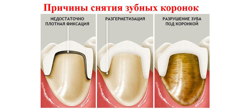 Болит зуб под коронкой при надавливании
