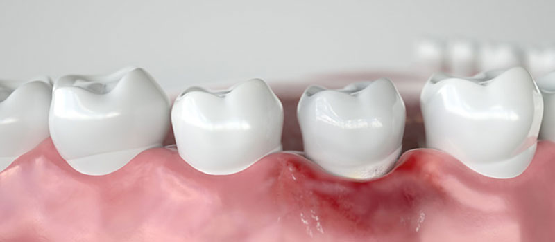 Что стоматологи называют воспалением десны?
