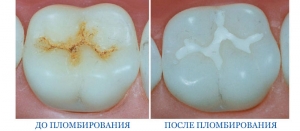 Коронка или пломба