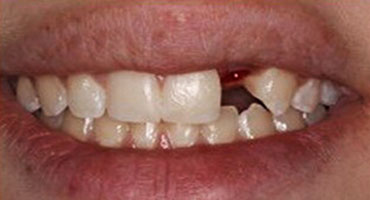 Имплантация зубов в Кудрово