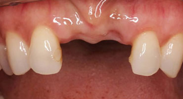 Имплантация зубов в Кудрово