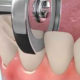 Механическая сепарация зубов