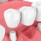 Мостовидный протез при утрате одного зуба