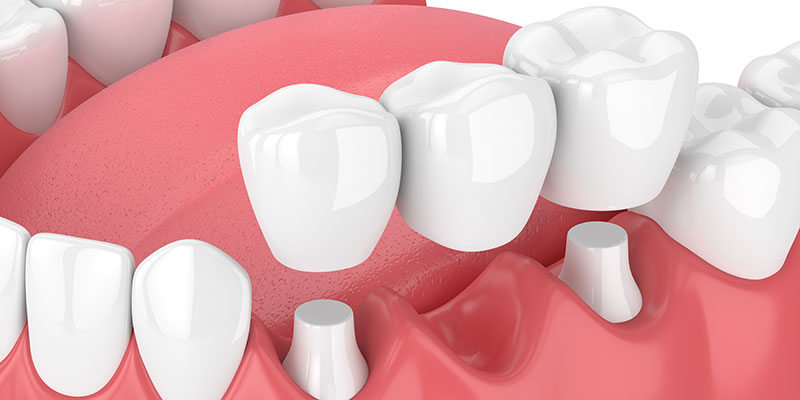 Мостовидный протез при утрате одного зуба