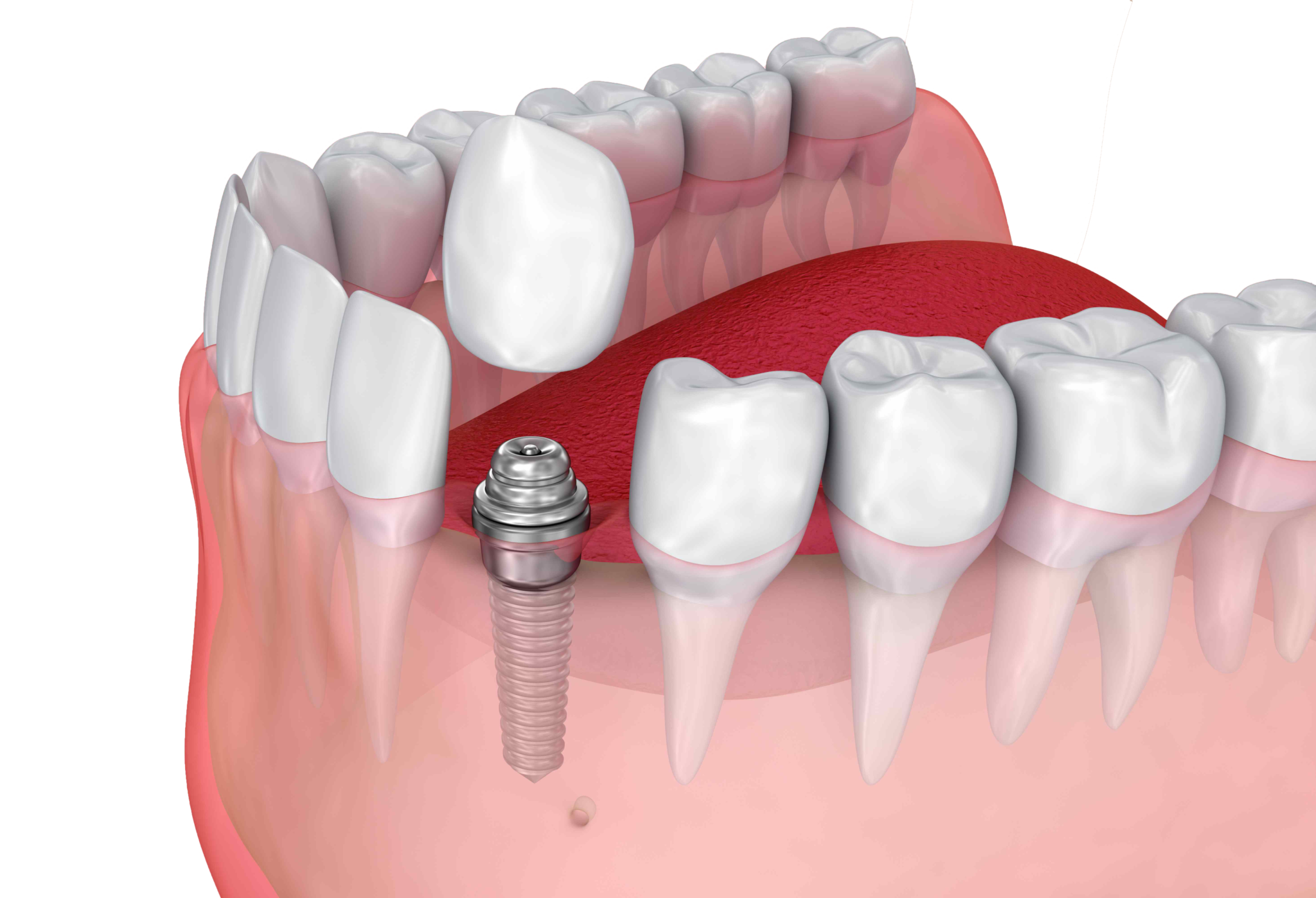 Endopore имплантат. Стоматология имплант.